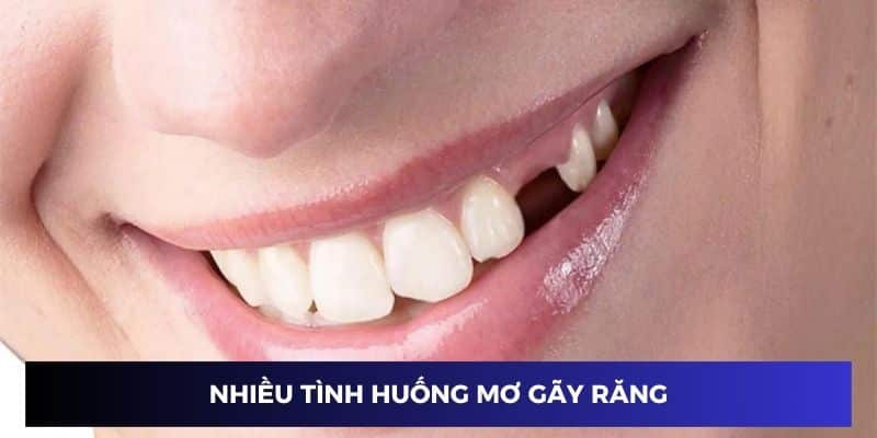 Nhiều tình huống chiêm bao thấy gãy răng